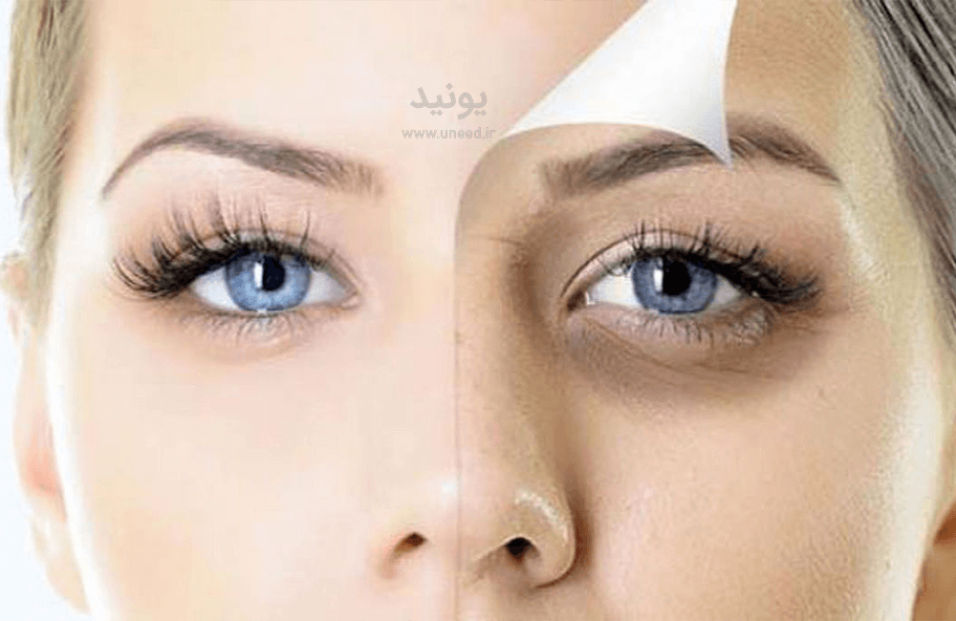 8 روش خانگی رفع تیرگی و گودی زیر چشم