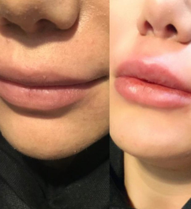 تزریق ژل و بوتاکس خدمات پوستی تزریق حرفه ای لب درمدلهای 
روسی قلوه ای 
چاکدار 
مادلینگ 
نچرال 
بوتاکس کل پیشانی خط اخم چین پنجه کلاغی دور چشم 
پیرسینگ تخصصی کل بدن ب روش تایلندی 

میکرونیدلینگ صورت رفع جای جوش منافذ باز رفع کدری پوست ولیفتینگ آبرسان عمیق صورت و لایه بردار 

چال گونه بدون کمترین درد و خونریزی با بخیه جذبی 
درمدلهای افقی عمودی نقطه ای 

هدف ما جلب رضایت مشتری سود کمتر مشتری بیشتر 
بامابدرخشید