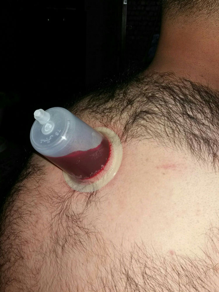 حجامت و زالودرمانی حجامت و زالو درمانی در منزل خودتان